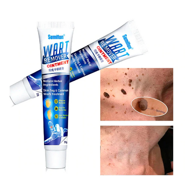 Remedio Natural para Verrugas